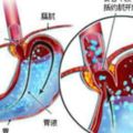 反流性食管炎的臨床症狀表現及最佳用藥治療方法！