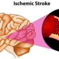 腦梗發生前，身體會發出一些5個「求救」信號，別掉以輕心！