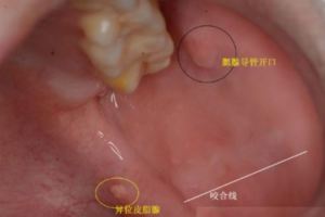 男孩得了「口腔癌」寶爸很後悔說：不該讓孩子吃！