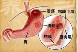 胃不舒服怎麼辦？慢性胃炎和胃痛的飲食建議有哪些？