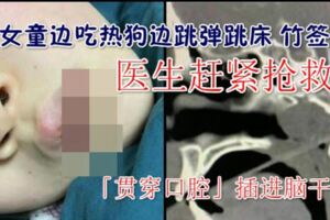 女童邊吃熱狗邊跳彈跳床竹簽「貫穿口腔」插進腦干，可能引發顱內出血、腦水腫