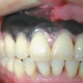 牙齒上出現這種症狀，你就要小心腫瘤了！就會隨著血流向肺部、肝髒、骨骼、腦部等器官轉移