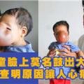 3歲女童臉上莫名鼓出大包，到醫院查明原因讓人心痛不已！