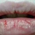 嘴唇經常性乾裂和起皮，這是什麼原因？