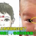 寶寶鼻樑上有青筋的注意了，這是「磨娘筋」，容易引發這些疾病！