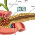 醫學家找到「癌症之王」元兇糖類竟跟恐怖胰髒癌有關