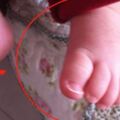 5歲孩子雙腳變形，只因長時間穿這種鞋子，家長要重視