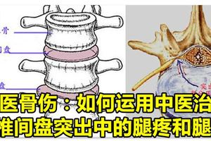 中醫骨傷：如何運用中醫治療，腰椎間盤突出中的腿疼和腿麻