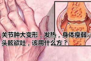 關節腫大變形，發熱，身體瘦弱，頭眩欲吐，該用什麼方？