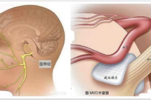 眼皮跳是面癱前兆？是福是禍怎麼分？持續性眼皮跳，可能是面神經出問題了