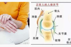 關節炎應拒吃8大類食物,小心越吃越痛、發炎惡化,加速關節變形!