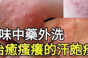 飽受瘙癢的「汗皰疹」痛苦的朋友，不妨試試！