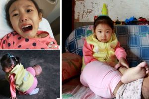 5歲漂亮女童腿粗如大象腳，無錢治在家疼痛難忍，靠吃止痛片，腿漸漸變粗，接下來可能面臨死亡