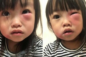 2歲萌妹被蚊子偷咬「隔天腫成一條線」　其他家長曬照：我家的更慘…