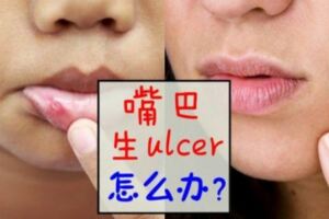 有一種說不出的痛叫做生ulcer？教你6招擊退嘴巴ulcer！