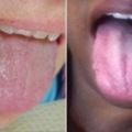請你馬上檢查看看你的舌頭是否有出現「皺摺」，它會出現的原因一定要知道啊！