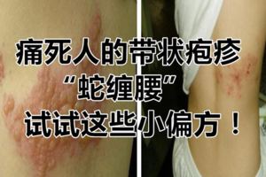痛死人的帶狀皰疹「蛇纏腰」，試試這些小偏方！