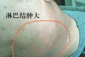 被診斷為4期淋巴癌的李開復，全身20多顆腫瘤細胞，怎麼治好的