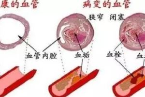 血管是這麼一天天被堵死的，別再默默喂養血栓了！這個進程必須知道