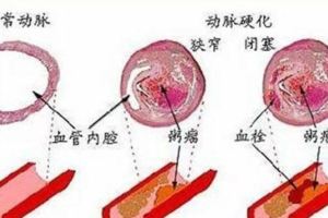 反復中風，非死即殘！這4條防中風方法，家有老人就要認真看看了
