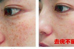 瘊子長在手上、臉上、脖子上，教你一個小方法，快速除掉瘊子