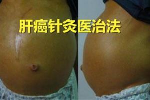 什麼才叫"針到病除"感受真正古老的"針灸"醫術!肝癌病串者