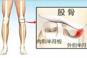 全面詳細介紹半月板損傷原因症狀治療鍛煉及預防建議收藏