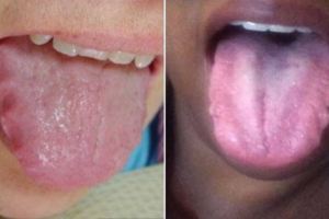 請你馬上檢查看看你的舌頭是否有出現「皺摺」，它會出現的原因一定要知道啊！