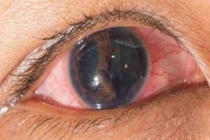 眼睛有紅血絲要警惕這幾種疾病