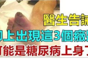 醫生告誡:腳上出現這3個症狀,可能是糖尿病已經上身了