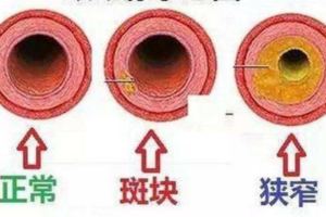 30歲後血管一年比一年堵，每天做到「三勤」，活到80也不得腦梗