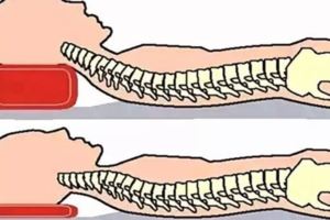 枕頭太高或太低都很傷頸椎，嚴重時可能導致癱瘓，頭要怎麼「枕」才能無憂？