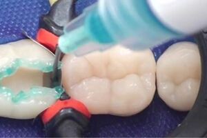蛀牙救星！科學家開發出「補牙凝膠」　「48小時內」再生琺瑯質