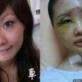 嘉義這妹子酒駕自撞「臉腫成豬頭」男友嫌醜跟人跑了，恢復後發表這勸世文…連小三看了都忍不住按讚！