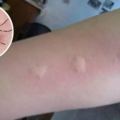 蚊子咬了腫一包奇癢難忍？越抓越癢！教你止癢方法，60秒後止癢去痕！
