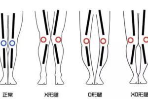 天生X/O/XO型腿？教你糾正腿型的針對性方法，還你一雙筆直長腿！