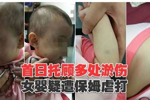 首日托顧多處淤傷女嬰疑遭保姆虐打