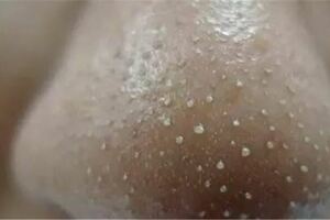 鼻子上可以擠出來的「白色條狀物」是什麼？該怎麼處理？一招教你輕鬆去除！