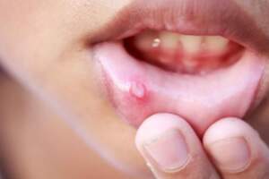 舌頭上這種現象，以為是口腔潰瘍？醫生提醒：幸好癌細胞沒擴散