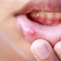 「嘴破」不知如何是好？教你7種「天然治療法」，嘴破永遠遠離你！