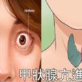 眼凸、怕熱、緊張失眠？當心「甲狀腺亢進」已鎖定你！遵循「四吃四不吃」讓甲狀腺重回平衡。