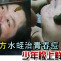 誤信偏方水蛭治青春痘少年臉上鮮血直流