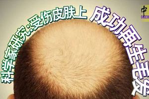 科學家研究：受傷皮膚上，成功再生毛發！逆轉變禿過程！