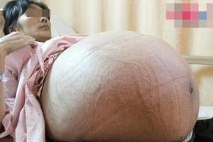 她為了生孩子吃下促排卵葯懷了9胞胎，醫生檢查后讓全家都崩潰了.... 