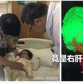 2歲女孩肚子像吹氣一樣越來越大，人卻越來越瘦！竟是右肝長腫瘤