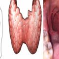 剛患上甲狀腺癌時，會有4個最好認的前兆，不容忽視！