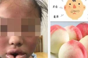 10歲女童咬了一口水蜜桃，嘴唇腫得像香腸，差點窒息