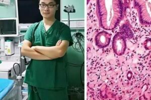 29歲女白領無症狀查出胃癌——醫生：晚查幾個月，後果無法預料