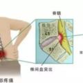 「最傷腰的6個姿勢」，你肯定天天在做！「3個簡單動作」拯救你的腰！