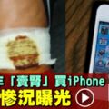 17歲少年「賣腎」買iPhone！7年後成傷殘人士！